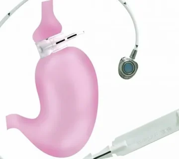 باندینگ معده