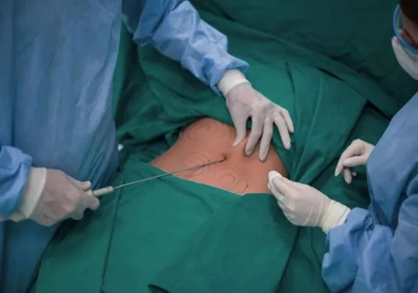 لیپوماتیک بهتر است یا لیپوساکشن