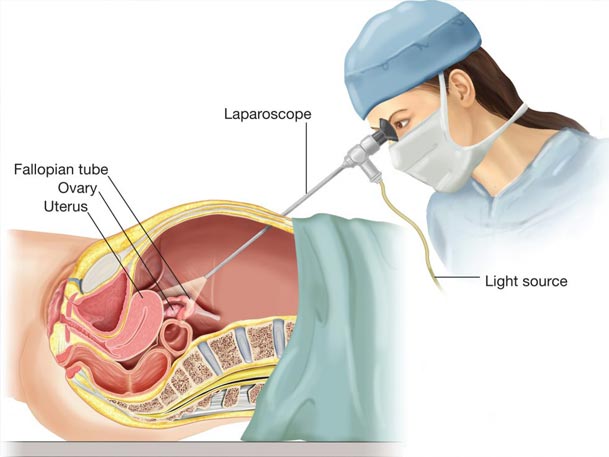 مزیت های فوق العاده جراحی لاپاراسکوپی چیست ؟