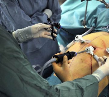 عوارض کوتاه مدت عمل جراحی چاقی چیست؟