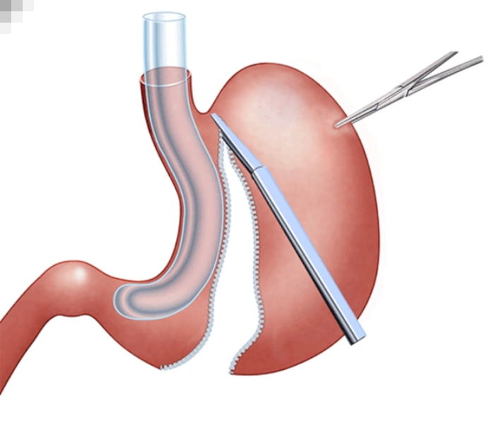 پلیسه معده با بهترین جراح لاغری در کاشان