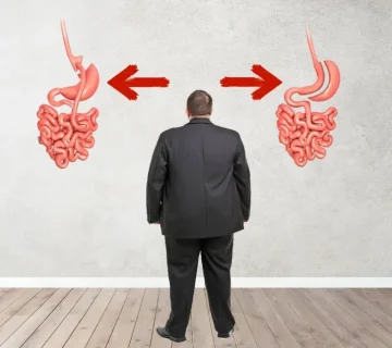 جراحی بای پس یا اسلیو