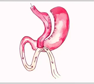 جراحی مینی بای پس
