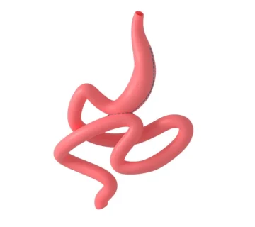 جراحی ساسی بای پس