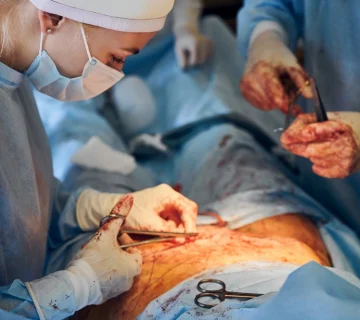 مراقبت های بعد از عمل بای پس معده