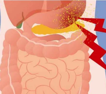 نشتی معده بعد از اسلیو