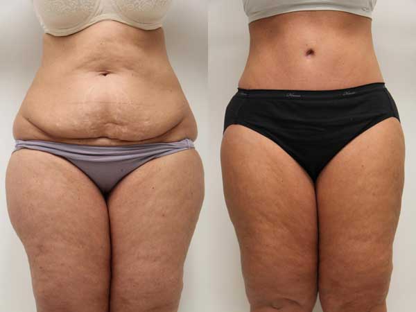 قبل و بعد از عمل زیبایی شکم