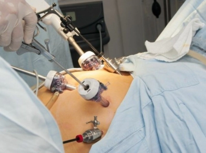 انجام عمل های لاغری به روش لاپاراسکوپی عوارض جراحی بای پس معده را کاهش می دهد