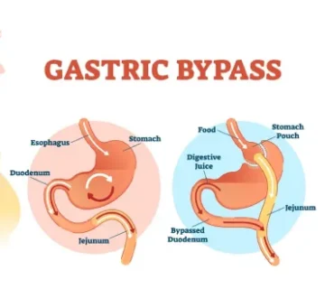 جراحی بای پس معده