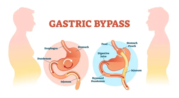 جراحی بای پس معده