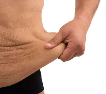 افتادگی پوست بعد از عمل اسلیو