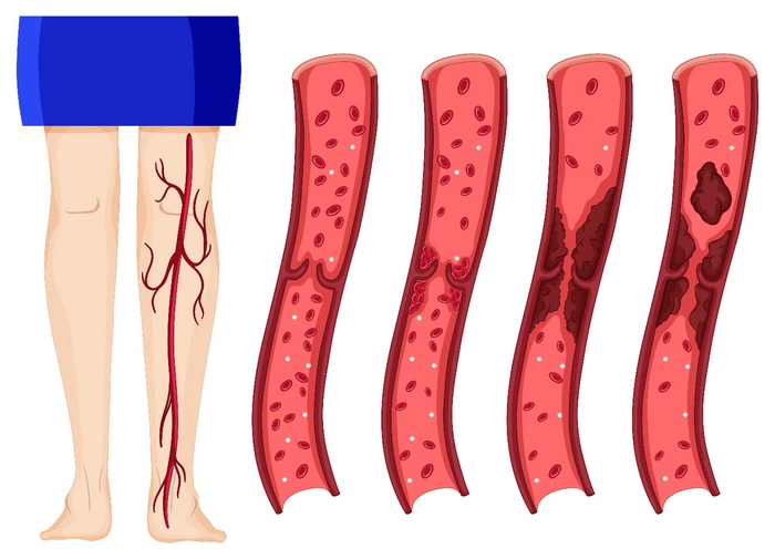 جدا شدن لخته‌ی خون از رگ، خطر بروز آمبولی ریوی را به همراه دارد.