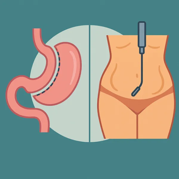 اسلیو معده بهتر است یا لیپوماتیک