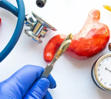 استپ وزن بعد از عمل اسلیو معده