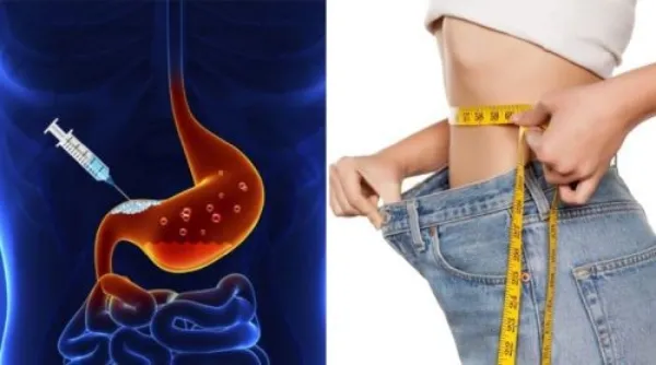 مراقبت‌های بعد از بوتاکس معده