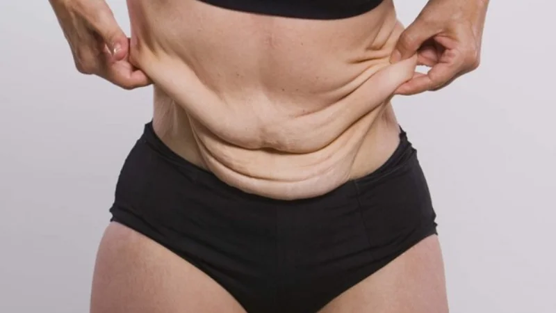 روش‌های جلوگیری از افتادگی پوست بعد کاهش وزن