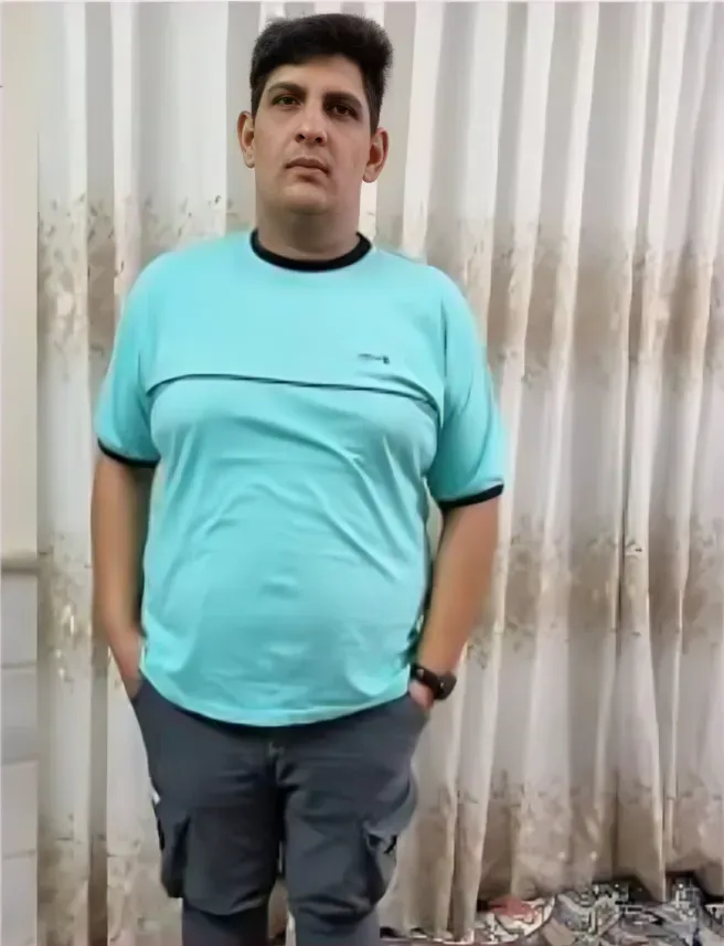جراحی ساسیج معده 42 کیلوگرم کاهش وزن در 3 ماه