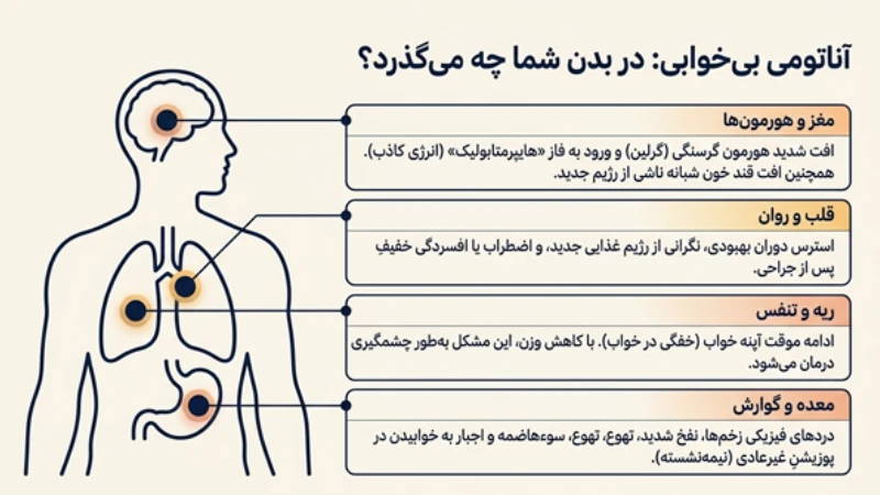 کم‌خوابی بعد از اسلیو معده