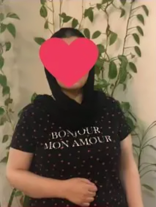 جراحی مینی بایپس معده 33 کیلوگرم کاهش وزن در 6 ماه