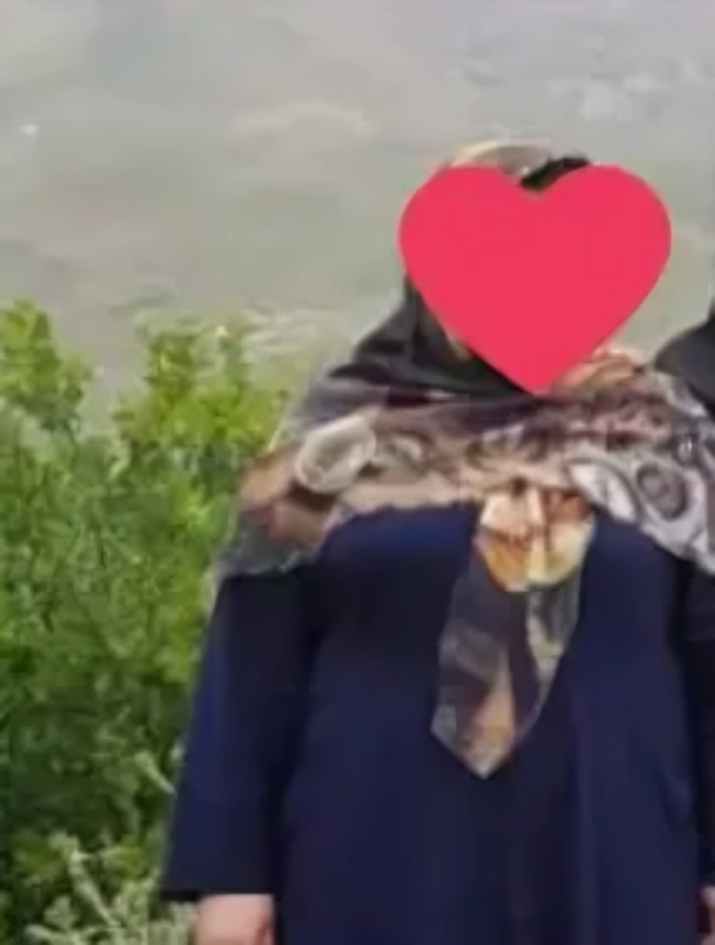 جراحی مینی بایپس معده 33 کیلوگرم کاهش وزن در 6 ماه