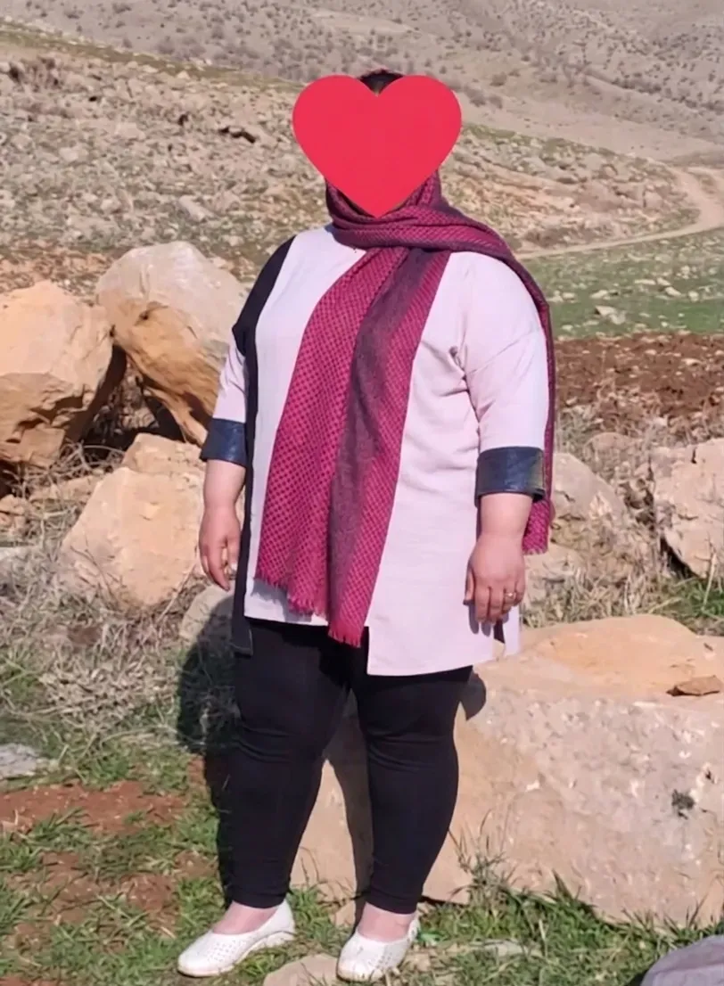جراحی مینی بایپس معده 40 کیلوگرم کاهش وزن در 6 ماه