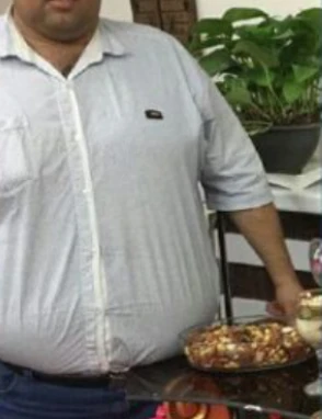 ۳۷ کیلو گرم کاهش وزن در طول ۶ ماه بعد از جراحی بایپس