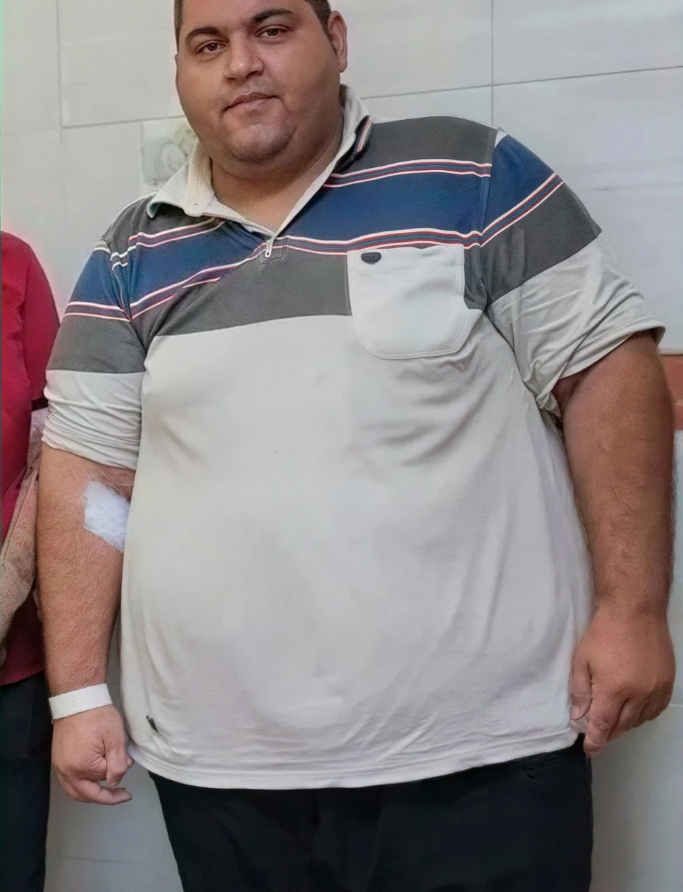 جراحی مینی بایپس معده 43 کیلوگرم کاهش وزن در 3 ماه