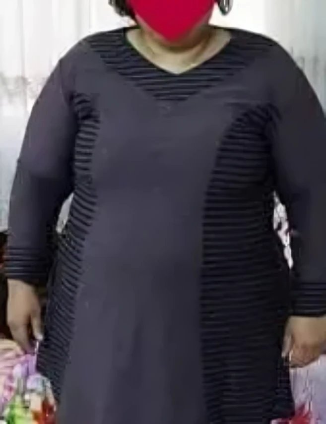 جراحی مینی بایپس معده 60 کیلوگرم کاهش وزن در 10 ماه