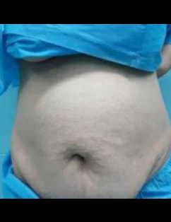 جراحی ابدومینوپلاستی