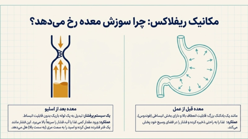 ریفلاکس معده بعد از جراحی