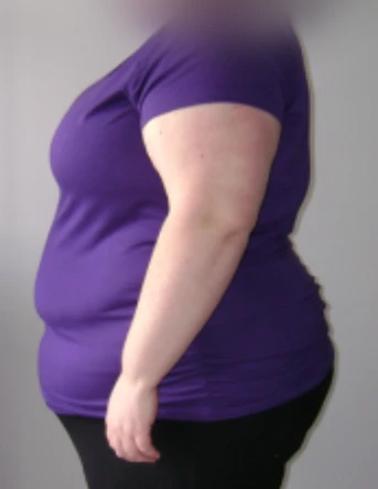 عمل لاپاراسکوپی خانم 40 ساله