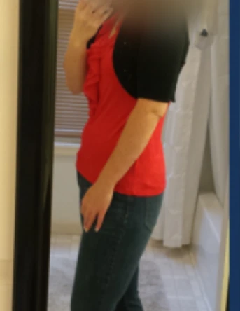 عمل لاپاراسکوپی خانم 40 ساله