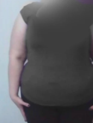 عمل لاپاراسکوپی خانم 54 ساله