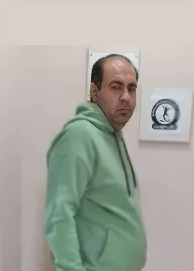 جراحی مینی بایپس معده 27 کیلوگرم کاهش وزن در 3 ماه
