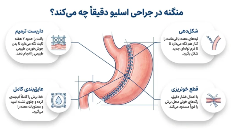 منگنه برای جراحی اسلیو معده