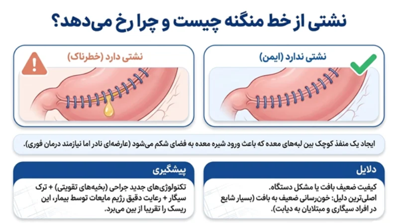 منگنه برای جراحی اسلیو معده