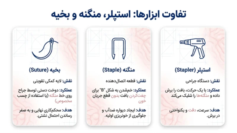 منگنه برای جراحی اسلیو معده