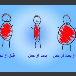 عمل اسلیو معده برگشت پذیر است