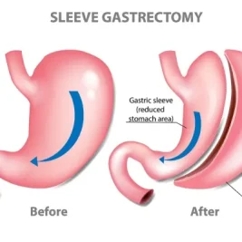 gastric-sleeve-surgery-1