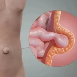 عمل فتق کشاله ران