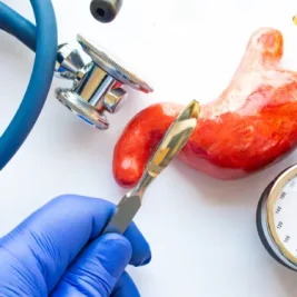 استپ وزن بعد از عمل اسلیو معده